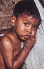 This photo of an infected child is included in the WHO slide set on the diagnosis of smallpox.