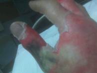 Figure 5. Burn injuries on the worker's right hand.