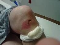 Figure 6. A blowout injury to the knee.