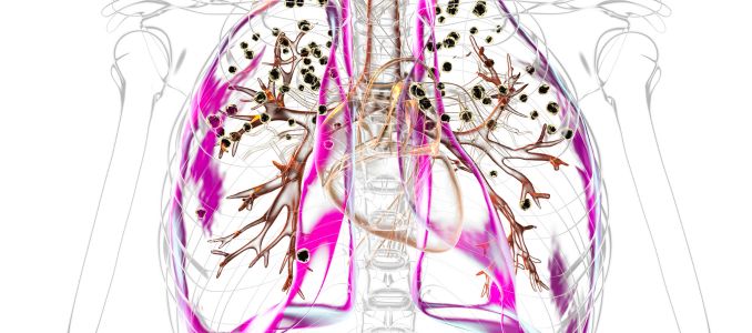 Lungs with Silicosis