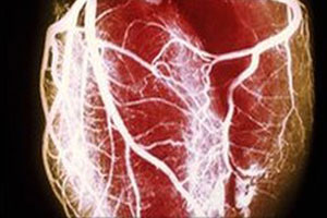 Approximately 92 percent of people who experience an out-of-hospital cardiac event die.