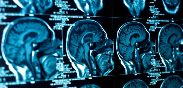 The two-year research study will attempt to correlate subsequent health problems, such as Alzheimer