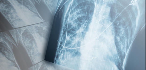 NIOSH also recommended a short-term exposure limit for 2,3-pentanedione of 31 parts per billion during a 15-minute period based on a concern that peak exposures may have increased toxicity than the same dose spread out for a longer period of time.